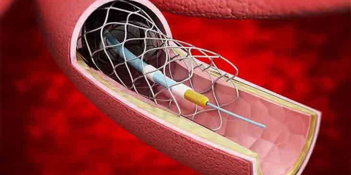 Non-Vascular Stents Market is expected to be valued at US$ 1.9 billion by 2032 | FMI