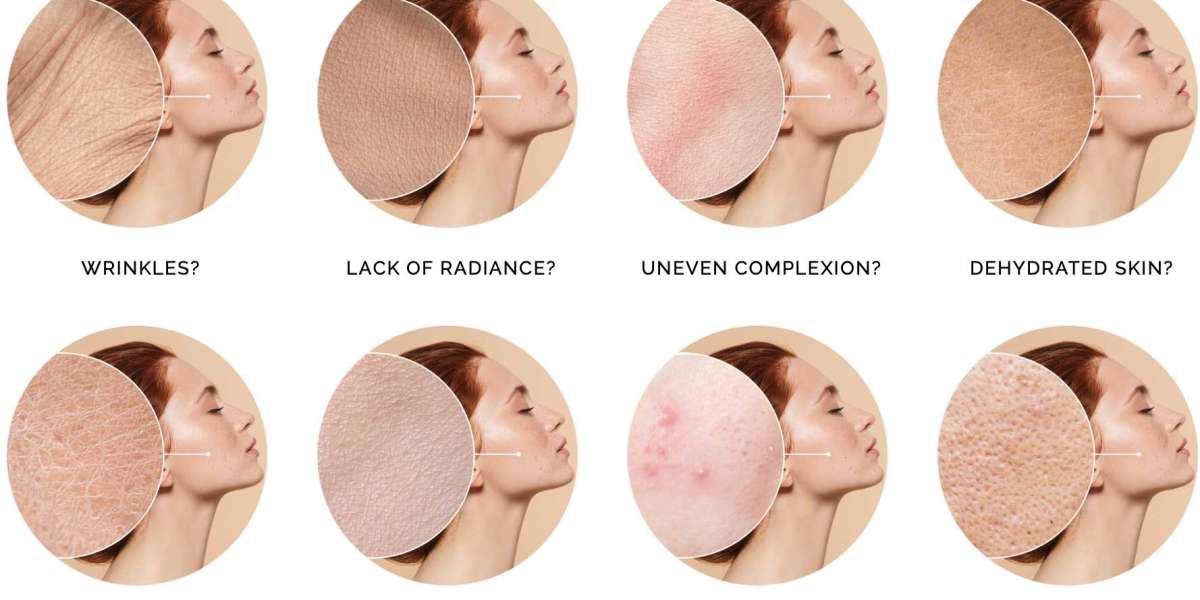 Why Does Everyone Like Amarose Skin Tag Remover?