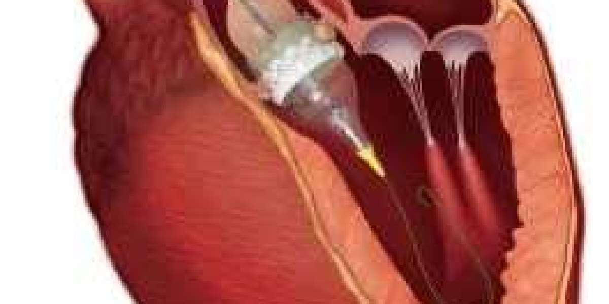 Transcatheter Heart Valve Replacement (TAVR) Market is expected to reach US$ 25.4 Billion by 2033 | FMI