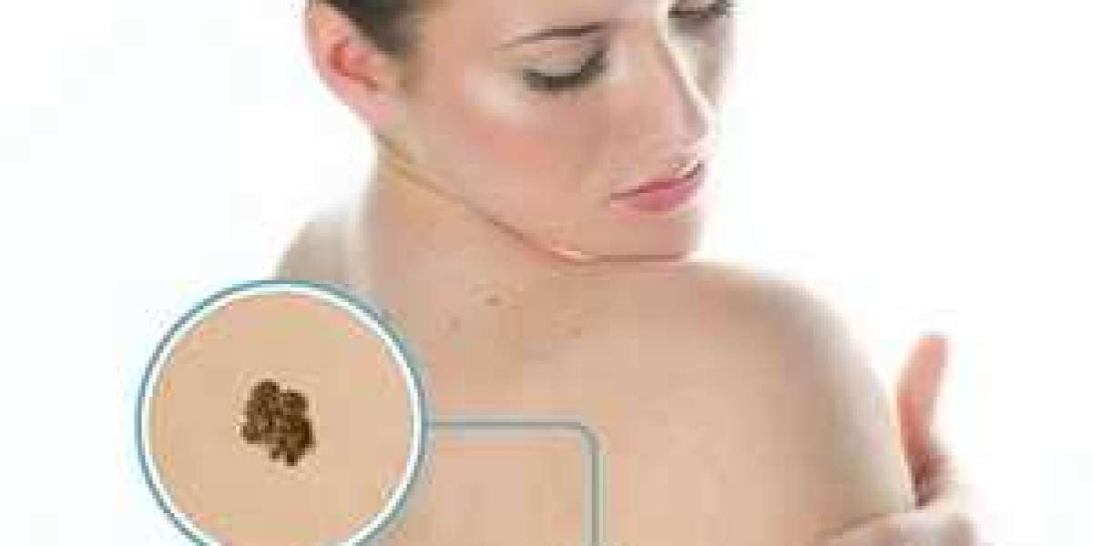 Nuvei Skin Tag Remover Reviews – Scam or So Smooth Skin Tag Mole Removal That Works?