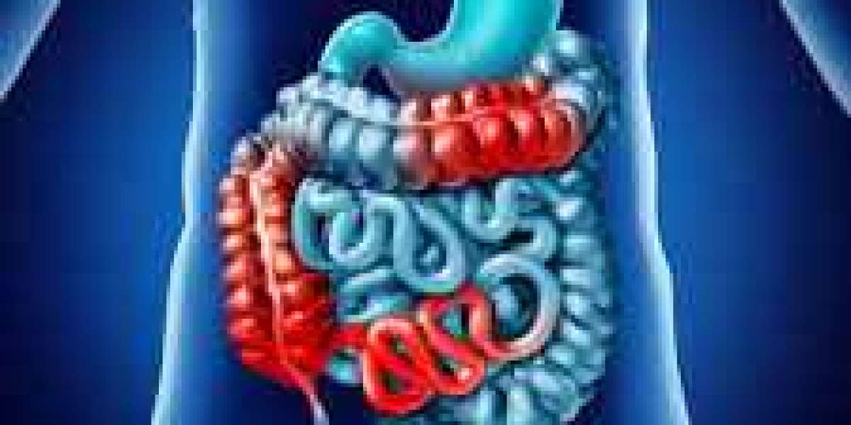 Crohn’s Disease (CD) Treatment Market Future Opportunities, Revenue Growth, Pricing And Profitability 2023 to 2033