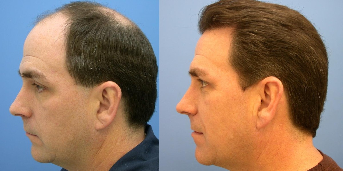 Hairline Lowering Surgery