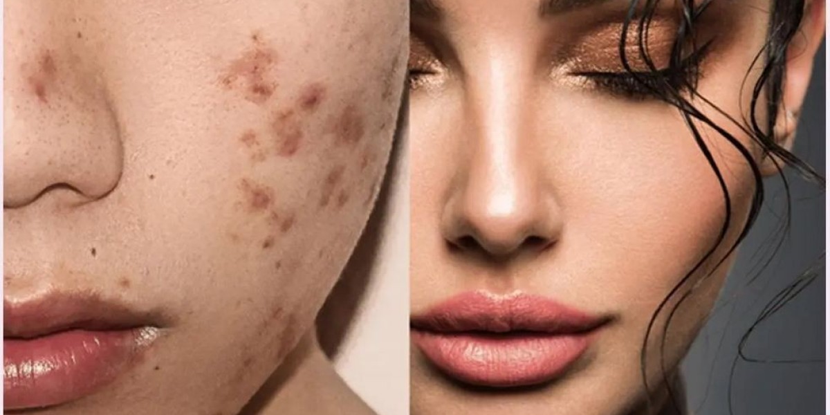 Utopia Skin Tag Remover Reviews 2023 (Fraud or Legit) Where to Buy?