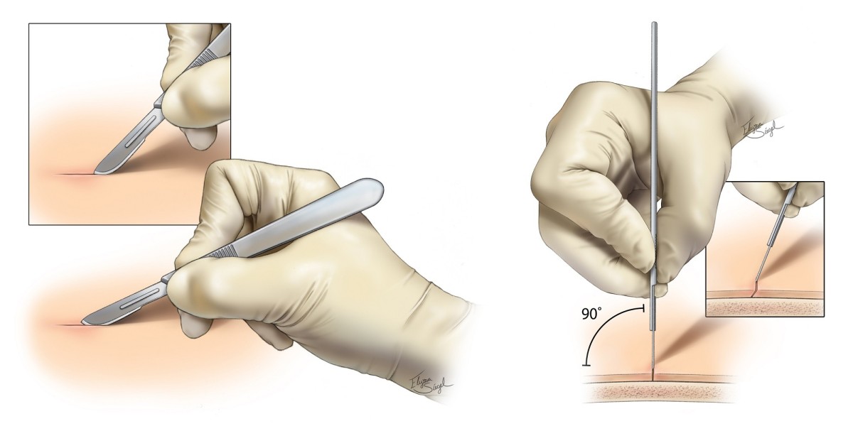 Alliances Between Major Research Institutes Benefit Surgical Scalpel Market