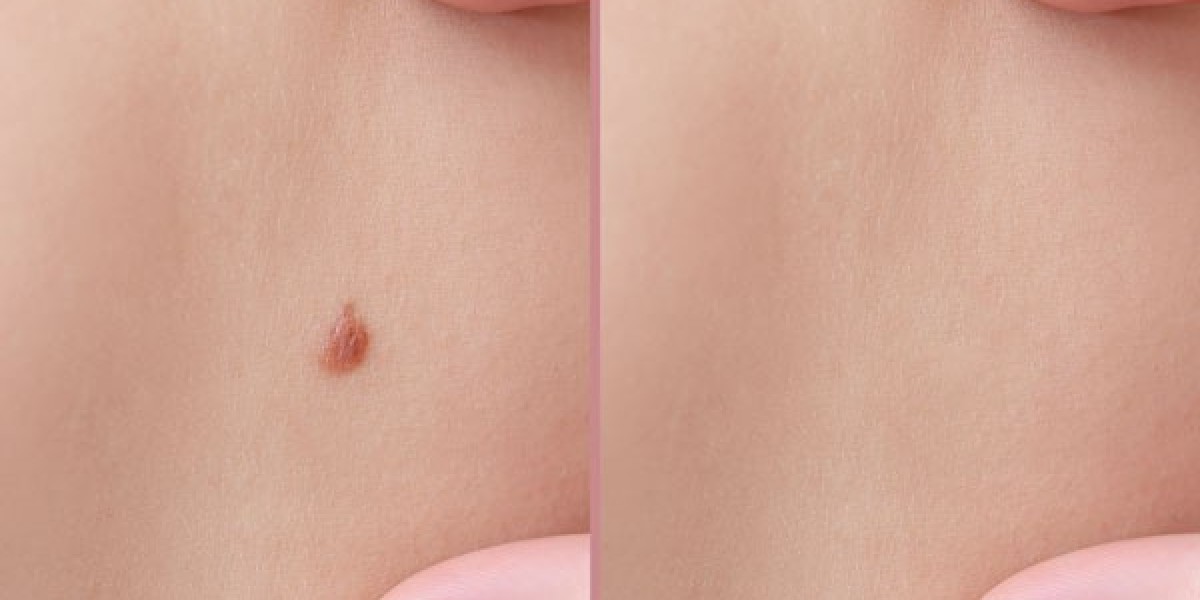 Can You Permanently Remove Moles?