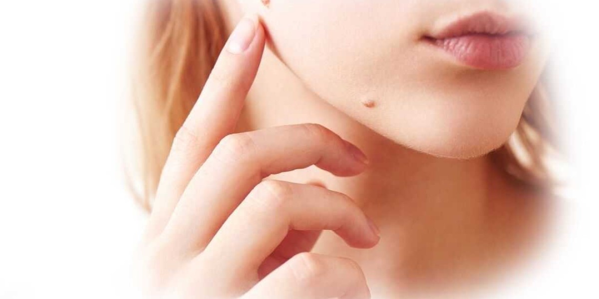 Skin Biotix Skin Tag Remover Reviews – Mole Removal Formula, Benefits & Price for Sale!