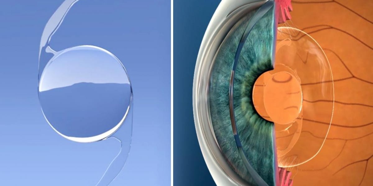 Comprehensive Analysis of Intraocular Lens Market 2023–2030 with Size and Future Scope