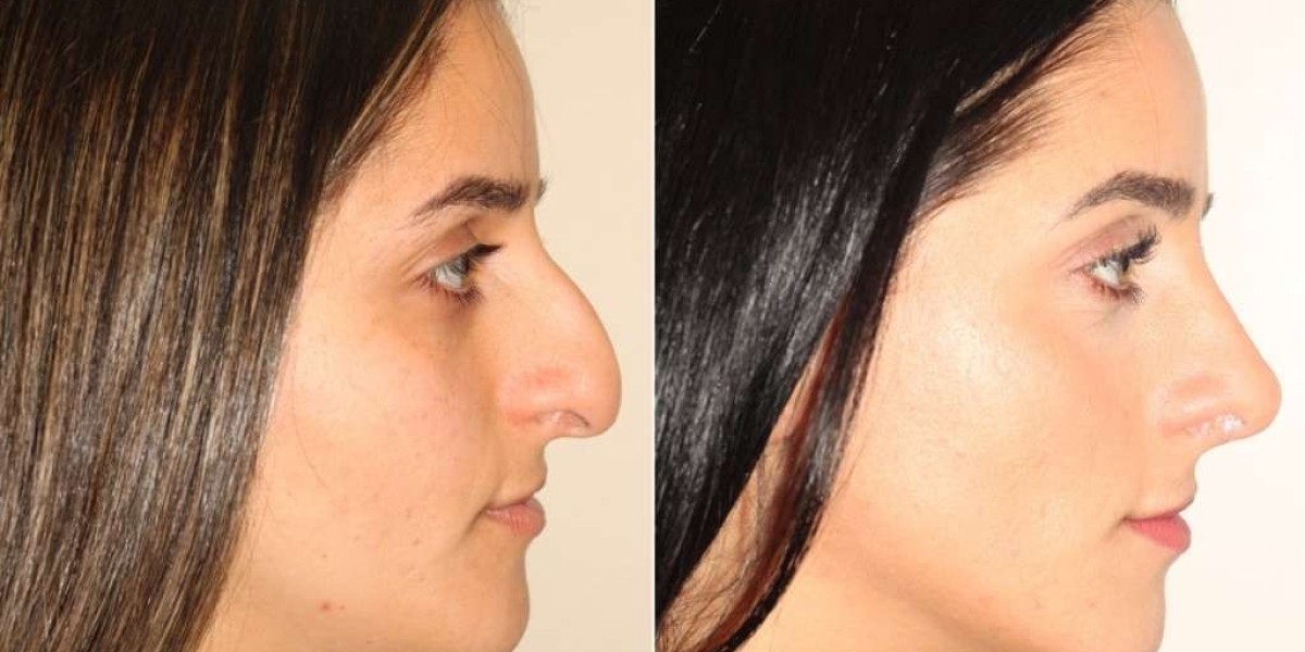 How to Prepare for a Successful Nose Surgery in Jaipur