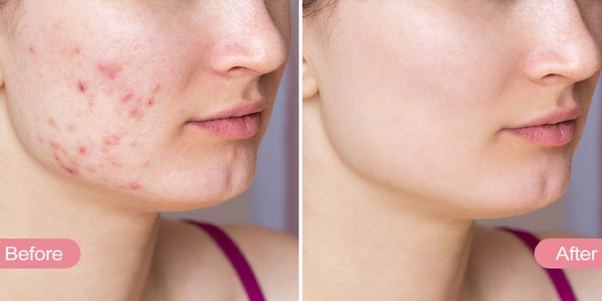 How can I get rid of acne marks?