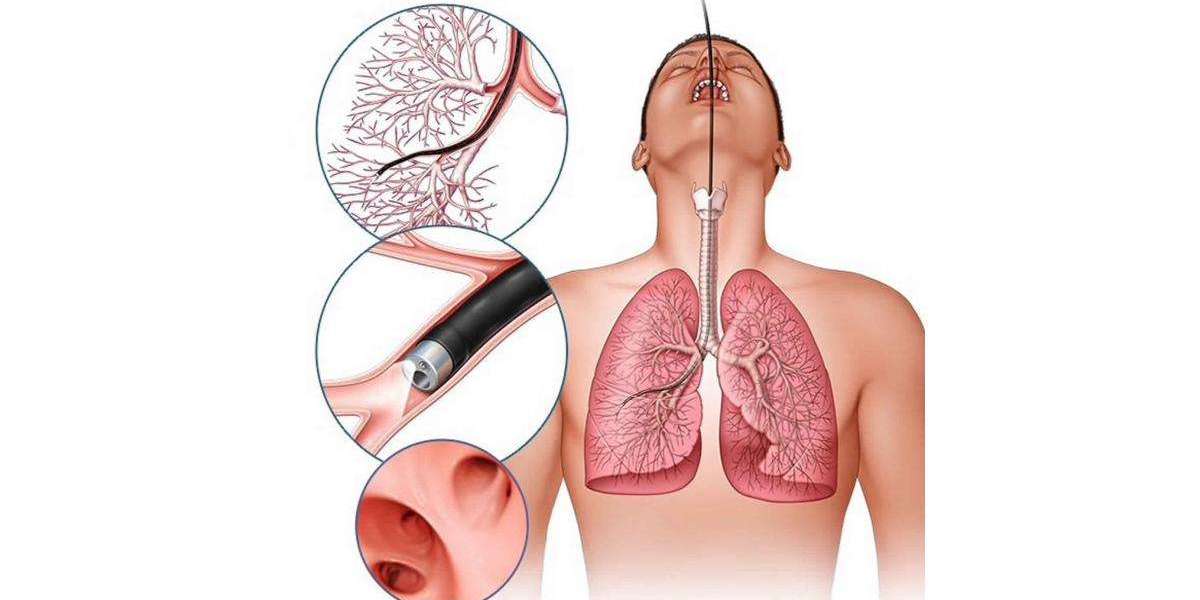 Lung Cancer Diagnostic and Screening Market to Reach US$ 1,931.0 Million by 2023