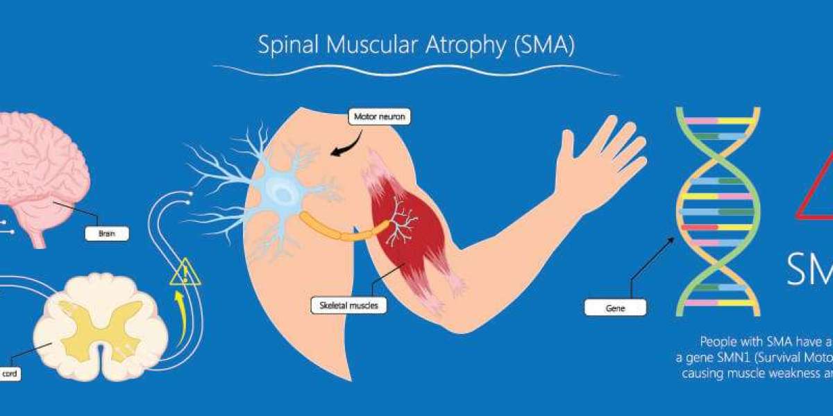Spinal Muscular Atrophy Market to Reach US$1,600.6 Million by 2023