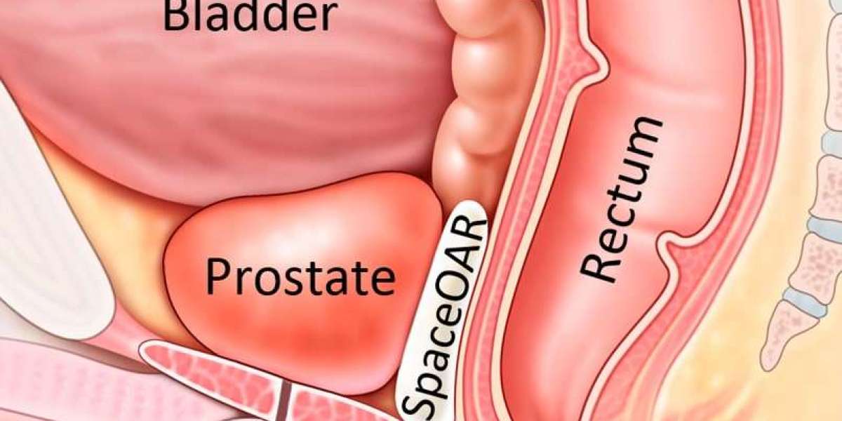 Prostate Gland Treatment - Pflow