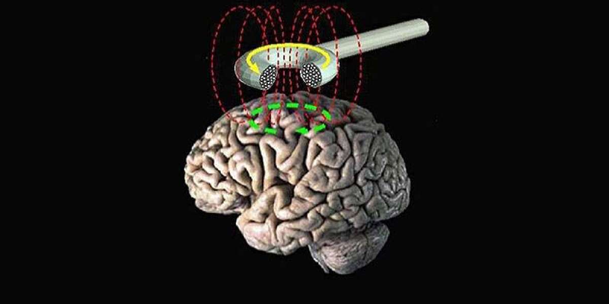 Rising Adoption of Noninvasive Brain Stimulation Devices to Drive Transcranial Magnetic Stimulator Market Growth