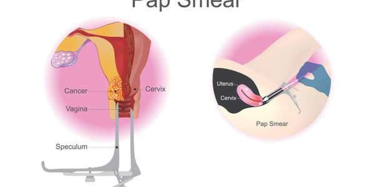"Demystifying the Pap Smear: A Crucial Screening for Women's Health"