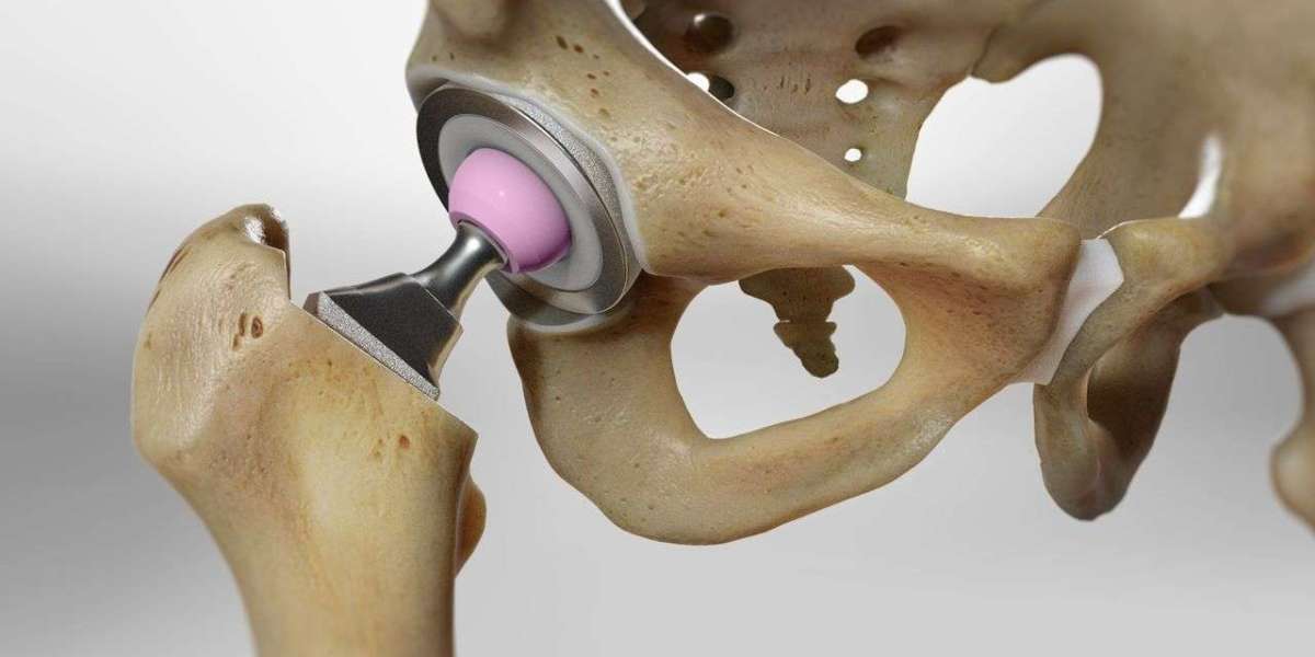 Hip Replacement Market Share, Size, Key Players, In-Depth Insights and Forecast 2024-2032