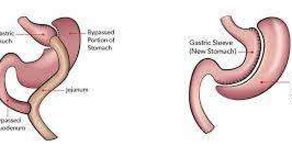 Bariatric Surgery Market Size, Share Analysis, Key Companies, and Forecast To 2030