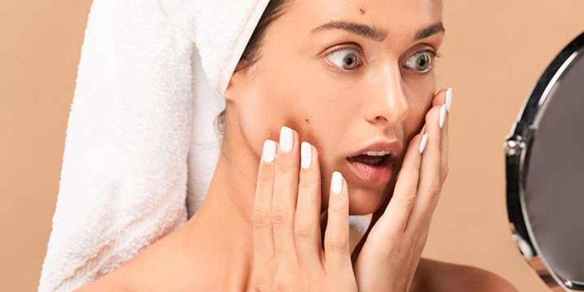 How to Get Rid of Hormonal Body Acne on the Back?
