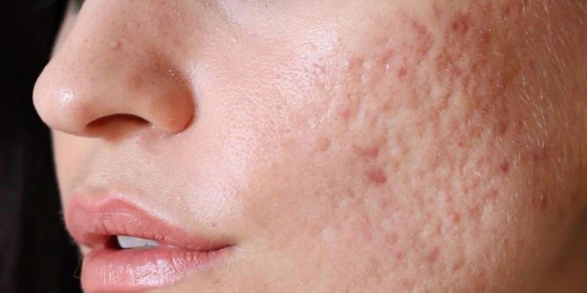 Understanding the Different Types of Acne Scars and How to Treat Them