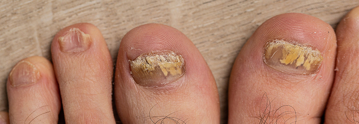 Combatting Toenail Fungus: 3 Key Strategies and 3 Pitfalls to Sidestep – Blizzard