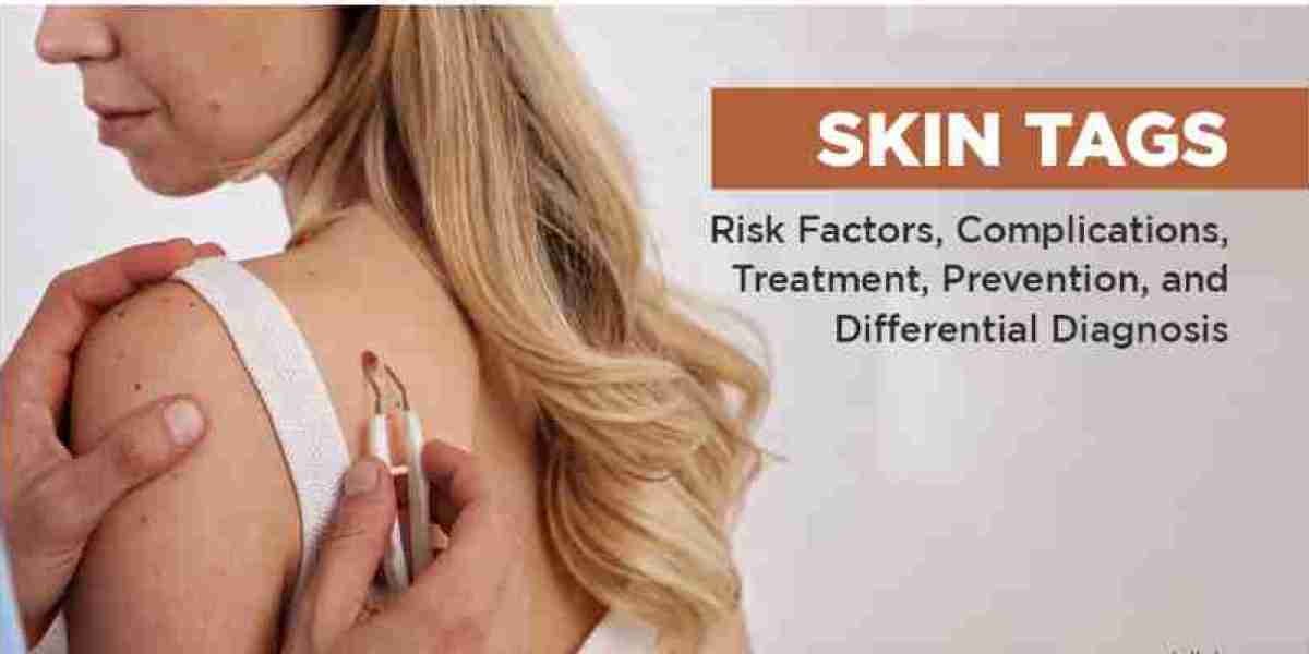 SkinFix Skin Tag Remover: Mole & Tag Benefits, Learn How To Care Of Your Skin!