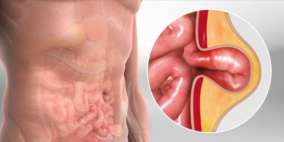 Best Hernia Specialist in Chennai - Dr. Pinak Dasgupta