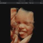 Ultrasound scan